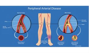 Leg Pain Isn’t Just ‘Old Age’— Diabetes Could Be to Blame