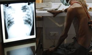 哥打丁宜通报一肺痨感染群，804人受筛检33人确诊