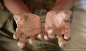 'Leprosy situation in Kuala Pilah under control, no isolation required'