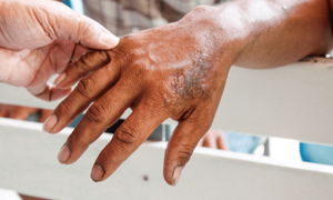 Leprosy: Preventive steps in place in 2 Orang Asli villages since August
