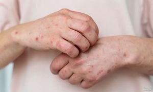Five new monkeypox cases detected